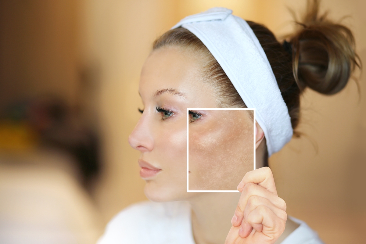 Melasma reaparece porque a pele mantém uma “memória”, explica médica