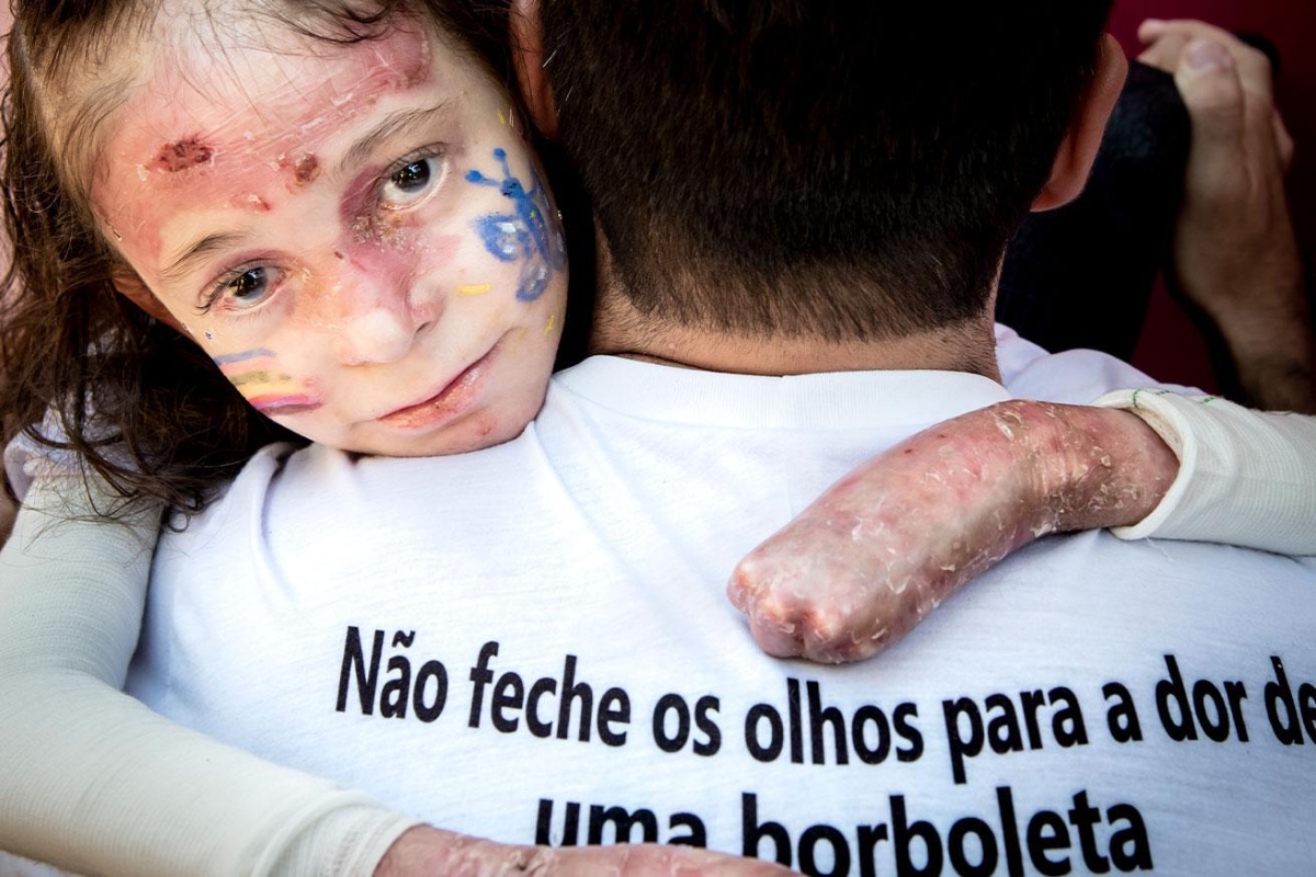 Imagem colorida - criança com Epidermólise Bolhosa - Metrópoles