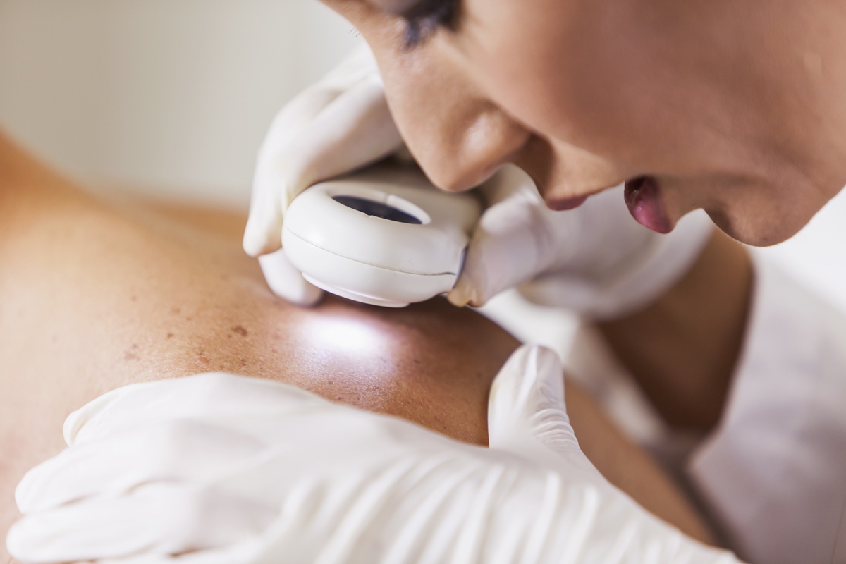 Dermatologista examinando a pele de um paciente do sexo masculino com dermascópio, observando cuidadosamente uma toupeira em busca de sinais de câncer de pele. - melasma