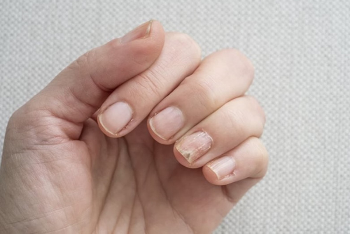 Foto colorida de pessoa mostrando as unhas - Metrópoles