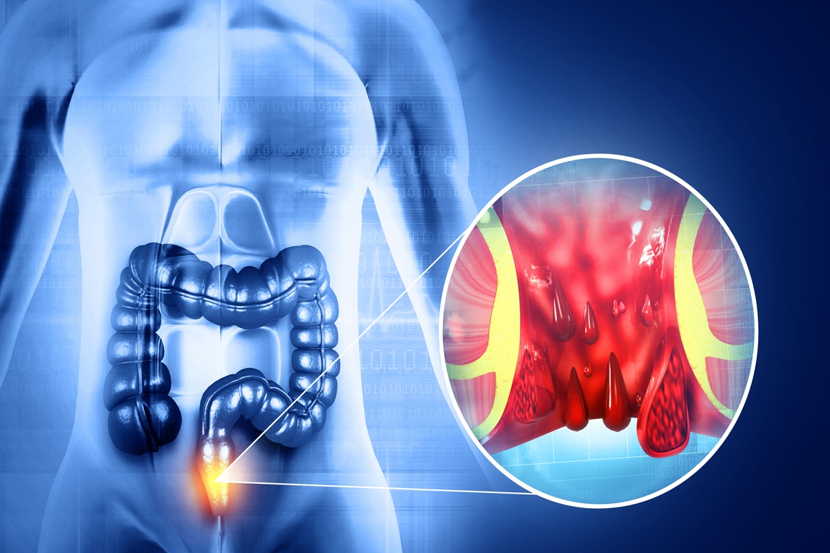 Ilustração médicamostra a formação das hemorroidas