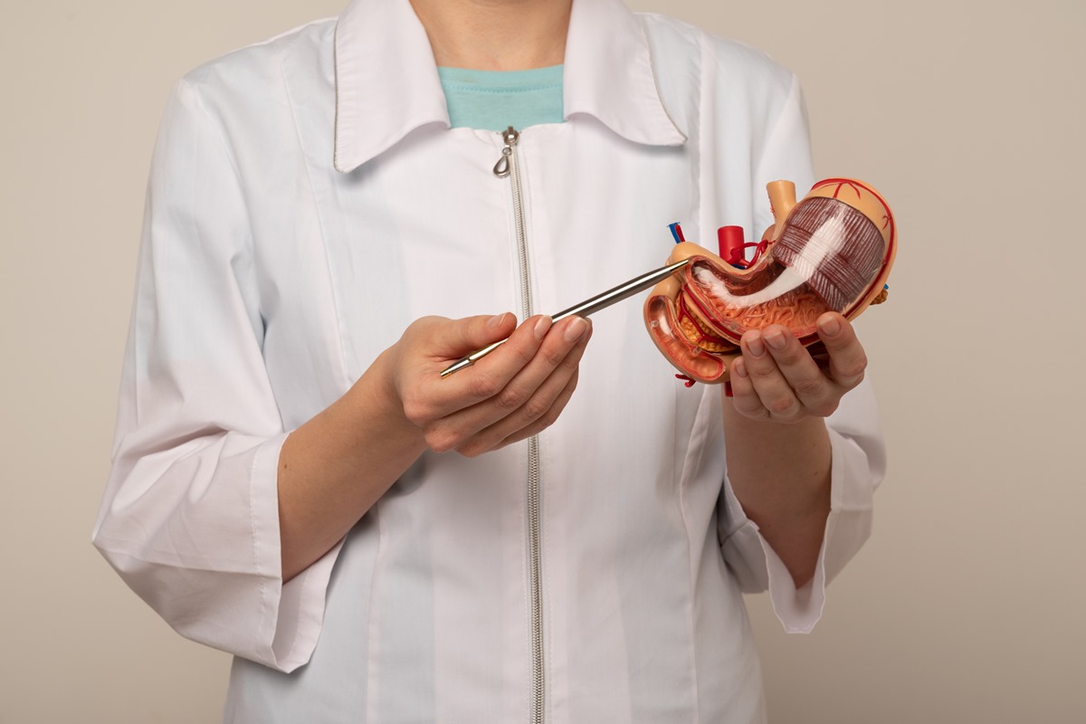 médica apontando para uma maquete de estômago. Conceito de cirurgia bariátrica