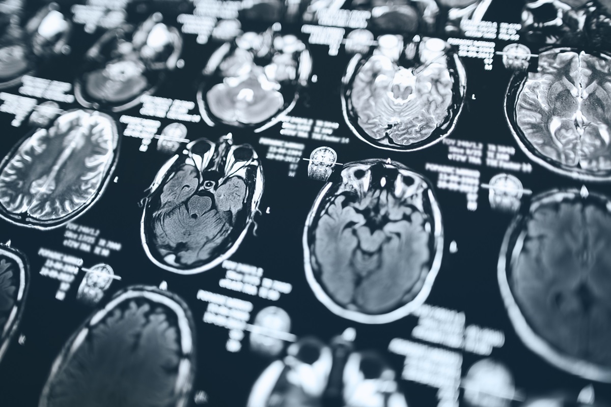 Ressonância magnética da cabeça, imagem por ressonância magnética da cabeça - Dieta mediterrânea pode reduzir risco de Alzheimer, diz estudo - - AVC