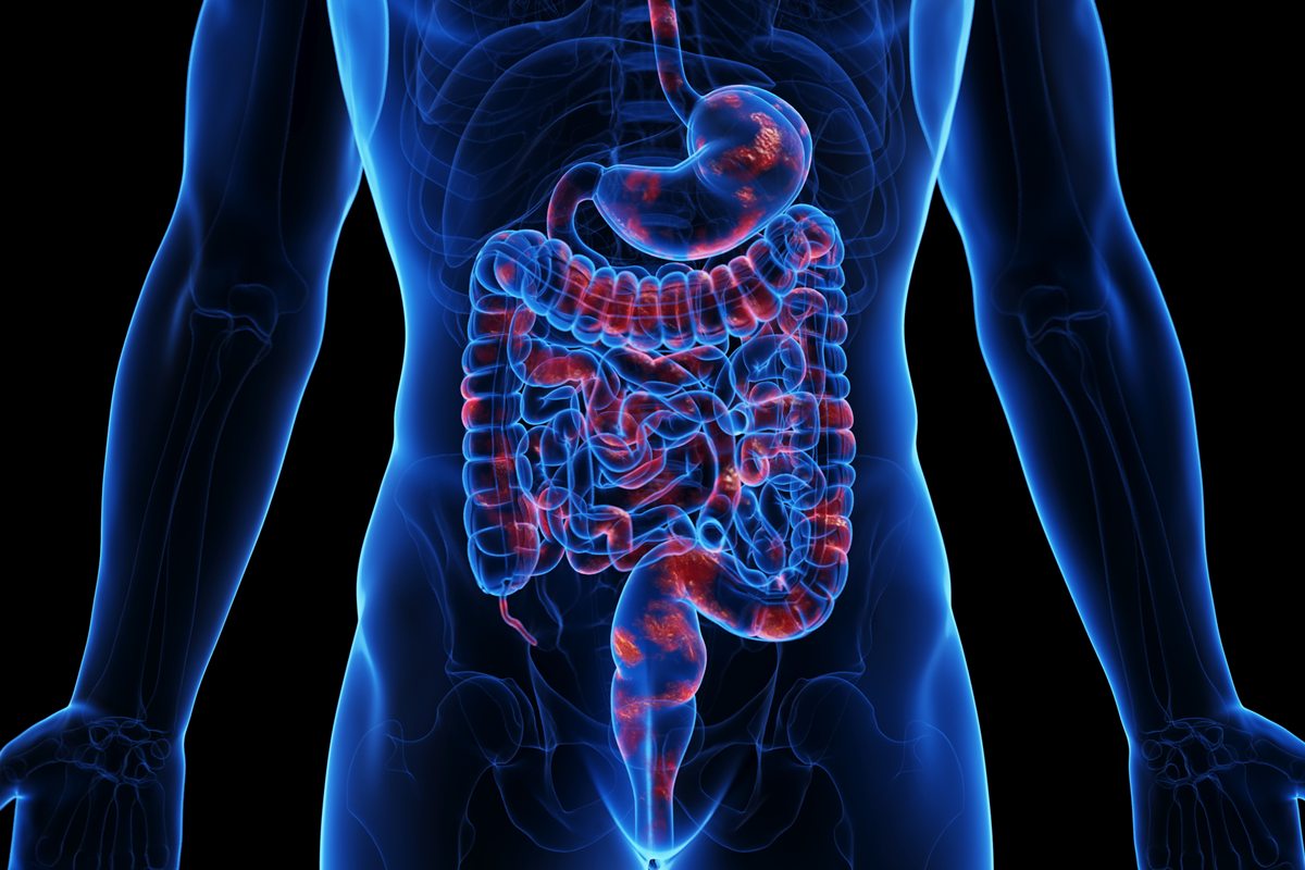 Ilustração de intestino com doença de Crohn - Metrópoles