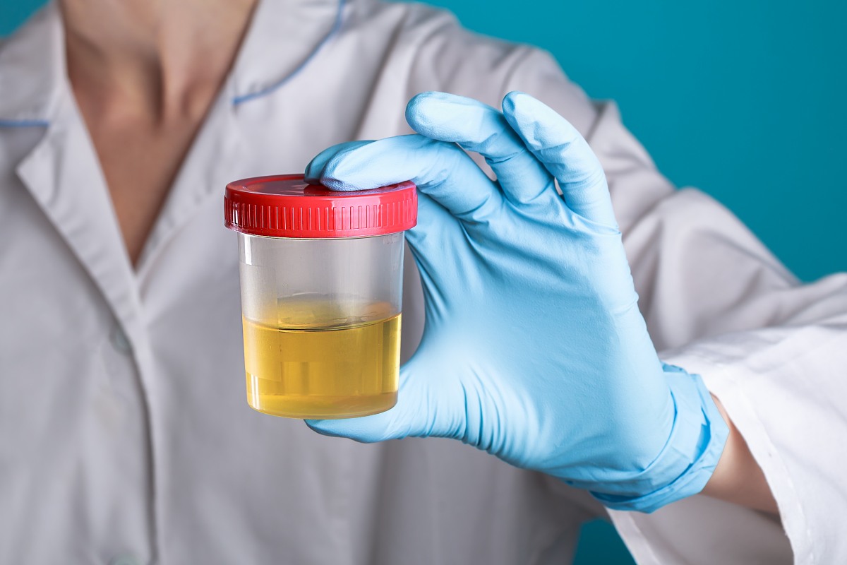 um médico de jaleco branco e luvas azuis segura uma lata de plástico com urina na mão. testes de urina para vírus, álcool, gravidez, drogas e doenças. Metrópoles
