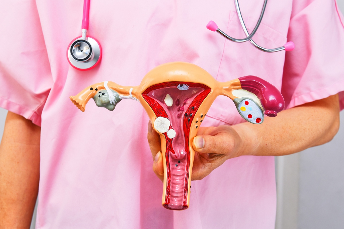 Cirurgião segurando modelo anatômico de patologias comuns. Conceito de câncer ou endometriose - Ginecologistas explicam os principais sinais de alerta da endometriose - Metrópoles