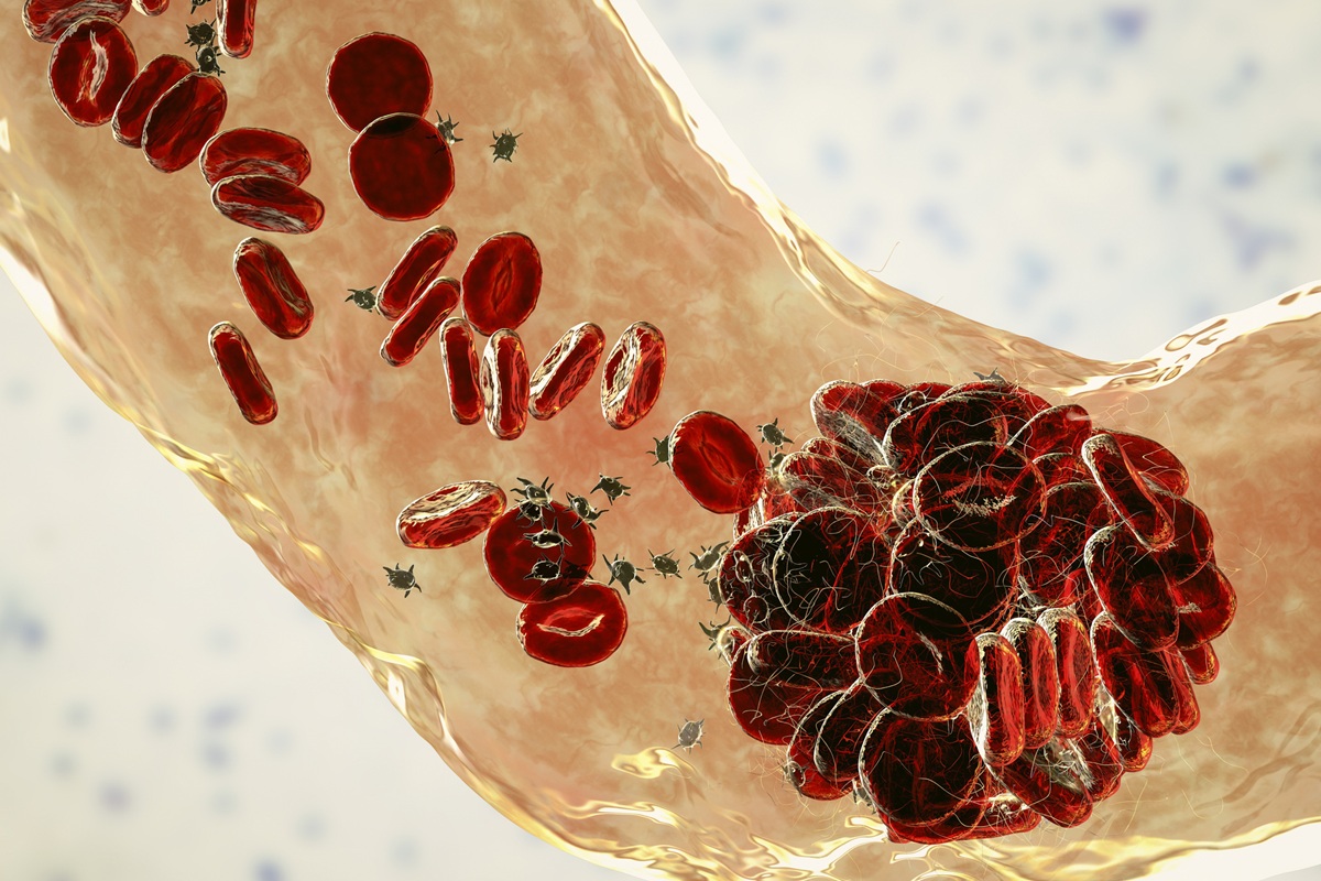 Médico vascular aponta fatores de risco e o que ajuda a prevenir a trombose - Foto