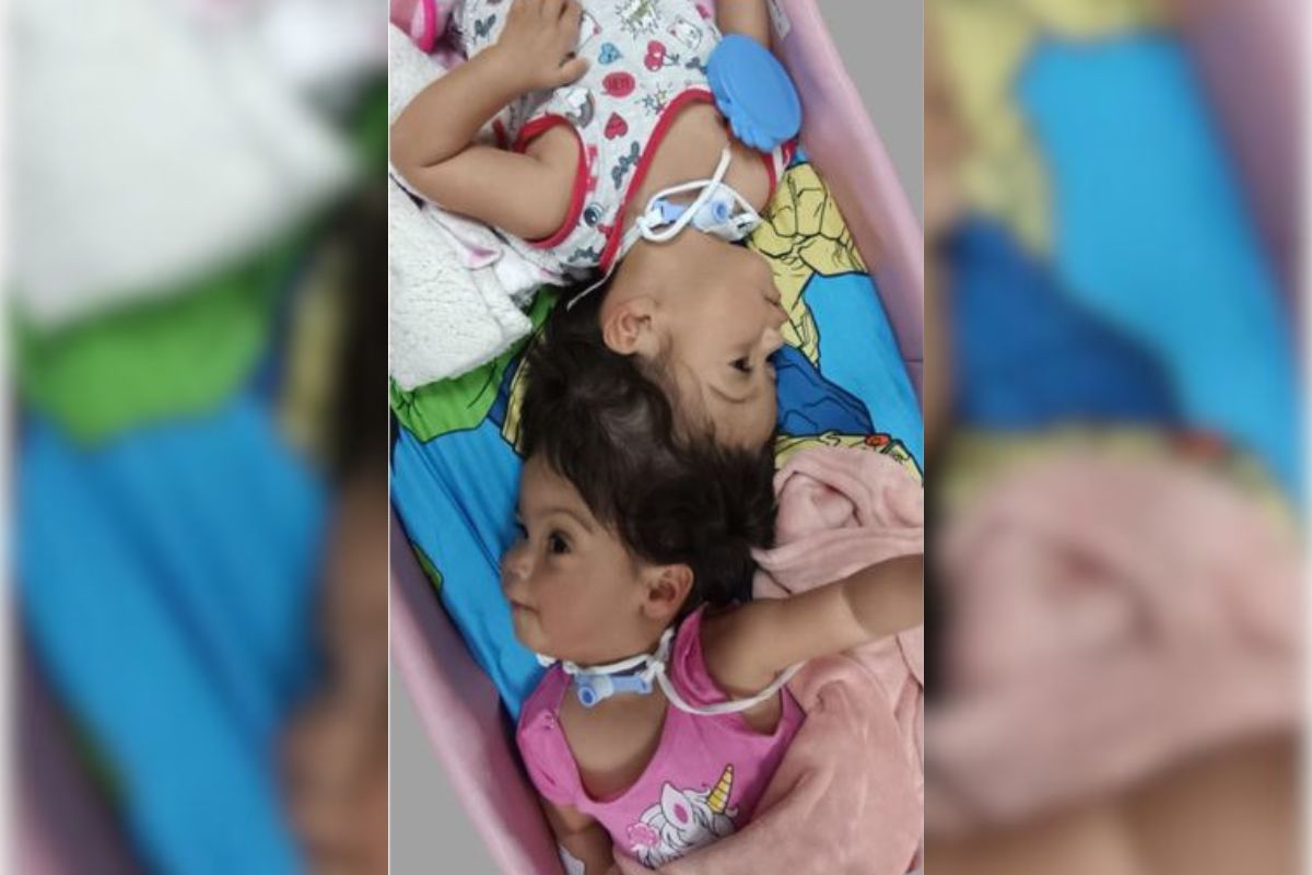 Tragédia: Gêmeas Siamesas Unidas pela Cabeça Perdem a Vida Após Cirurgia
