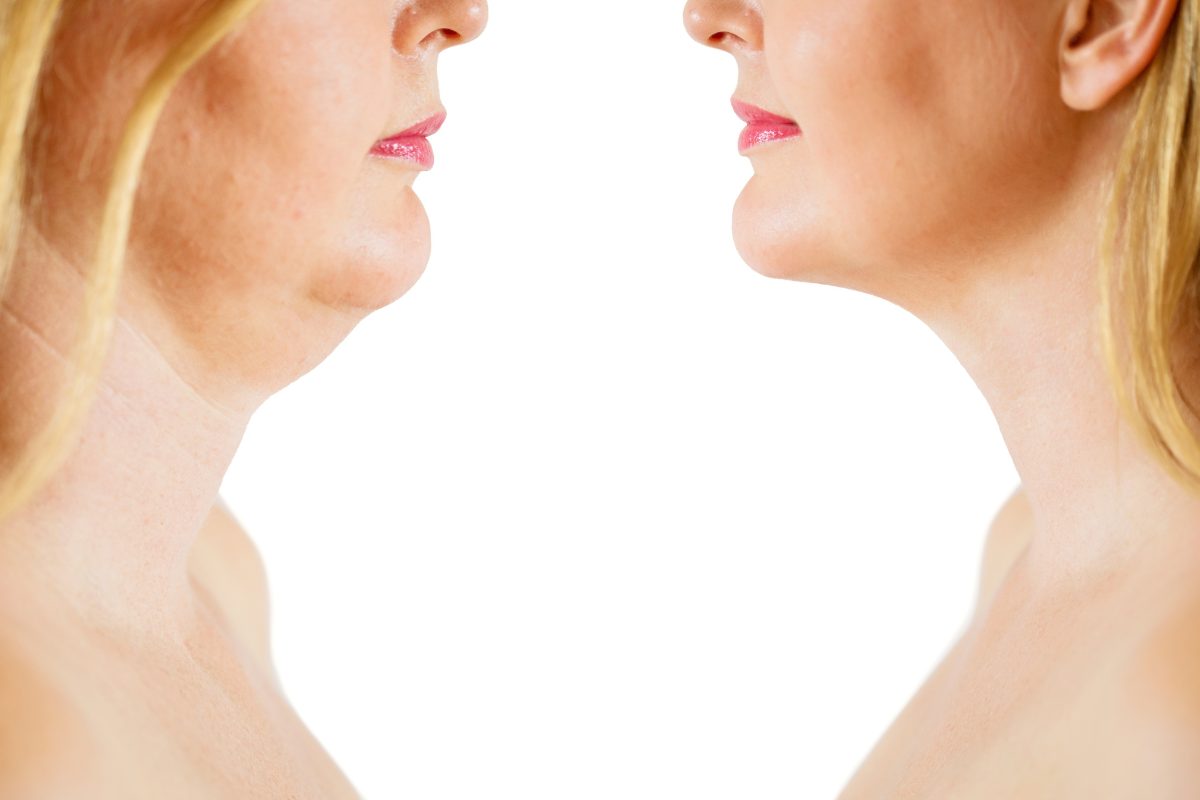 O procedimento pouco conhecido que promete rejuvenescer o rosto