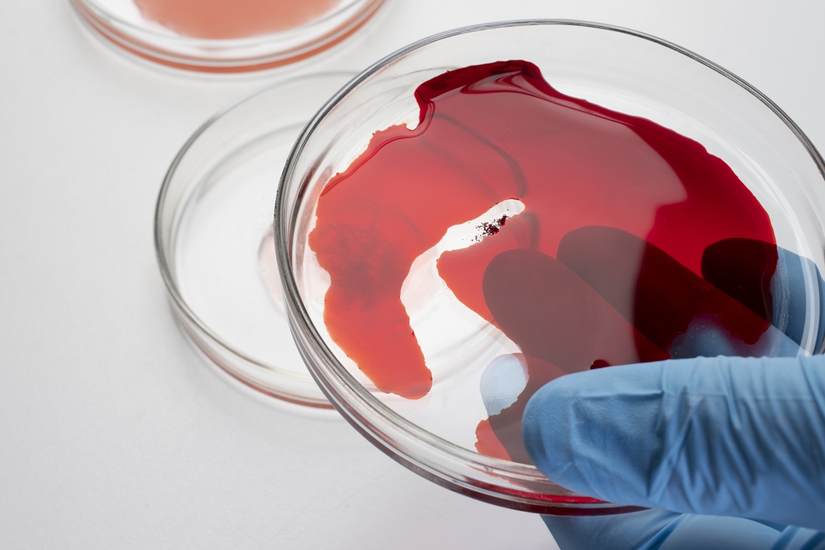 Exame de sangue ajuda a prever recidiva do câncer de pâncreas
