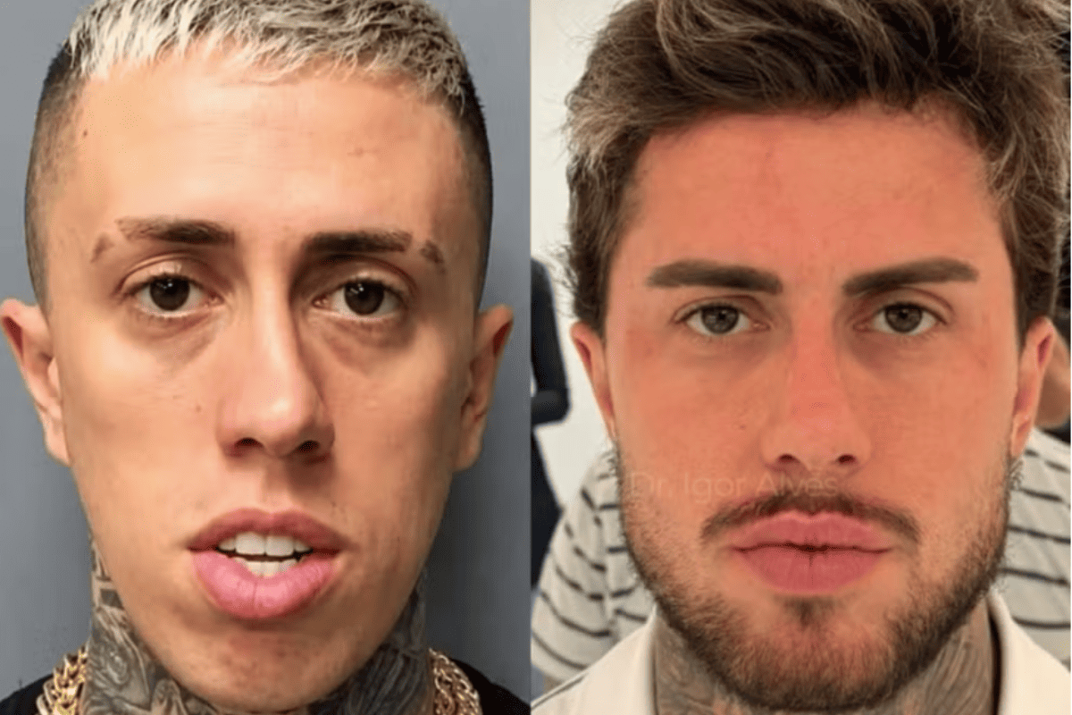 Botox e bioestimulador: entenda os procedimentos feitos por MC Daniel