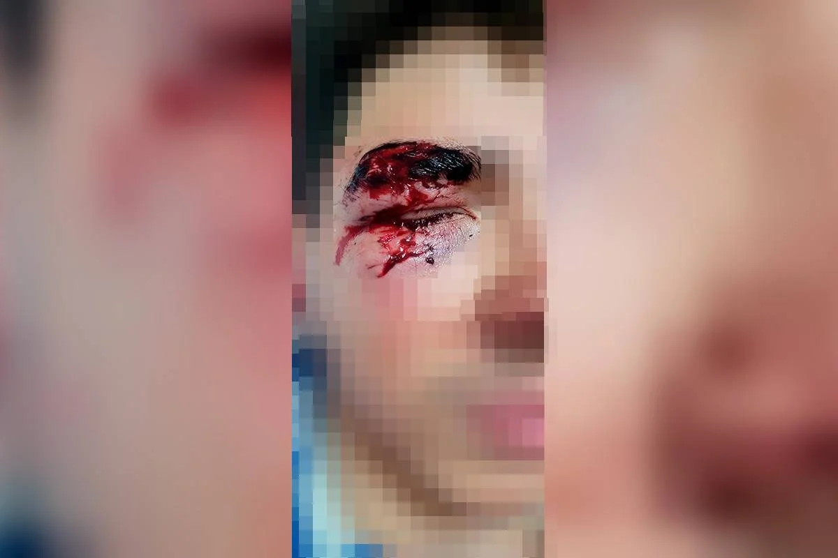 Imagem vinculada ao feed original: Jovem teve óculos quebrados por soco de morador de rua em Águas Claras