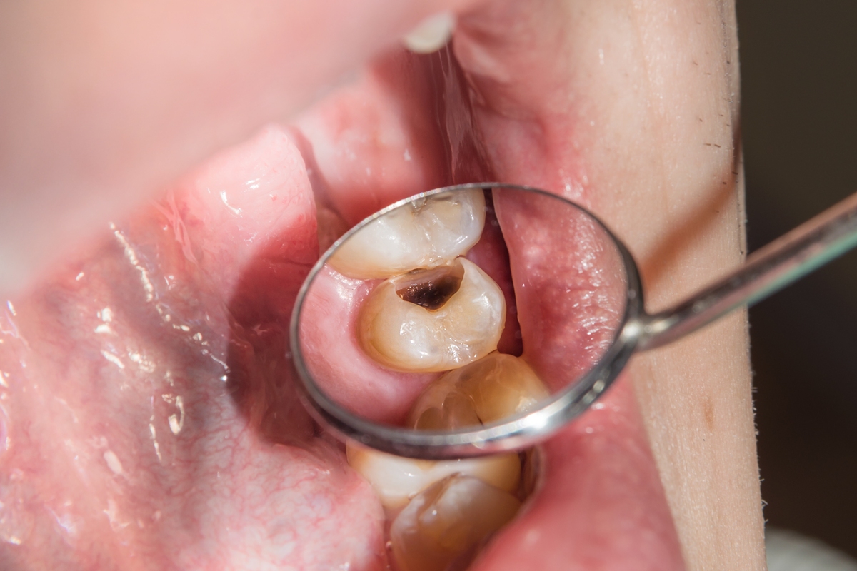 Foto colorida de dente com cárie - Metrópoles