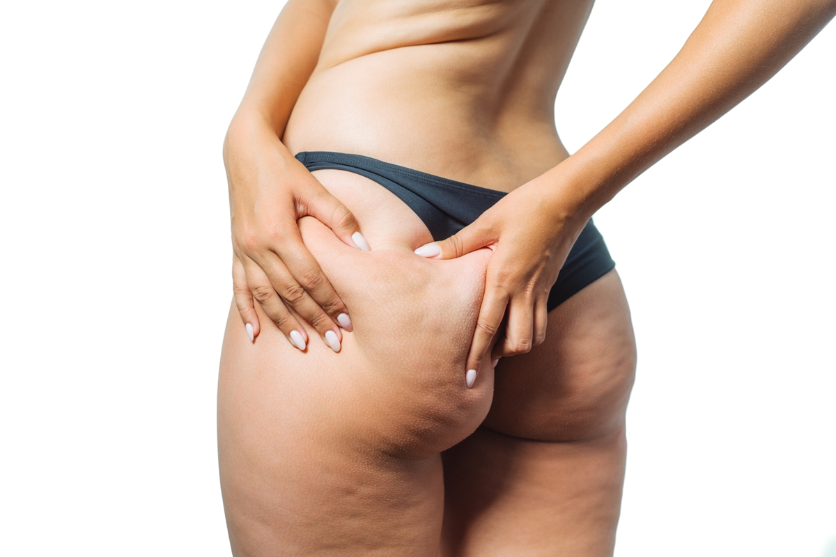 Personal elenca 4 exercícios que ajudam a reduzir a celulite no bumbum