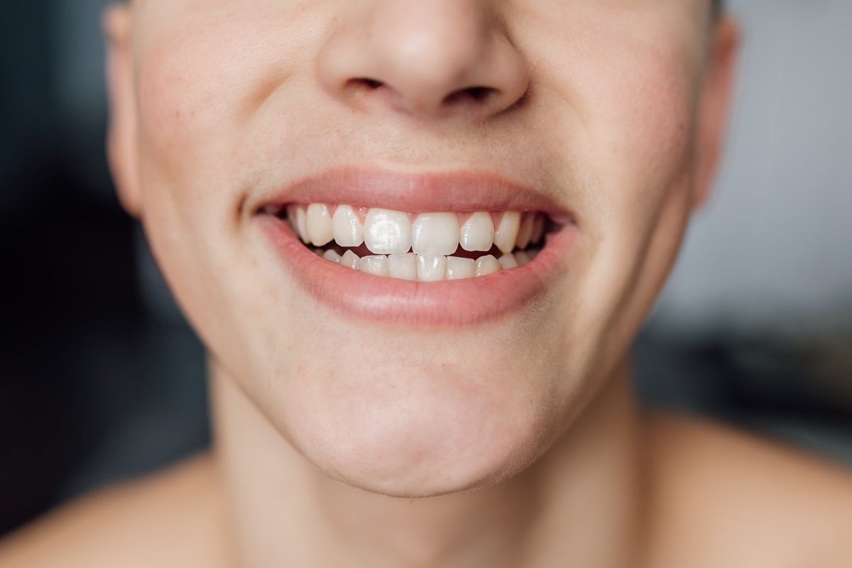 Foto colorida de dentes de uma mulher - Metrópoles