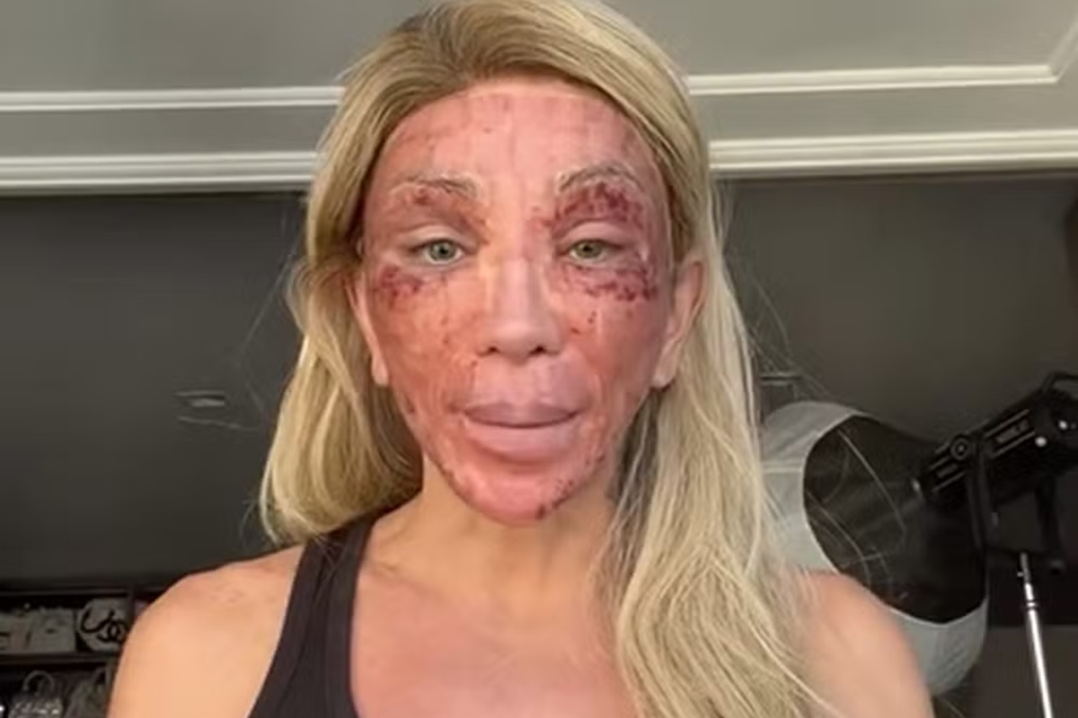 Maya Massafera choca ao aparecer com rosto ferido após peeling