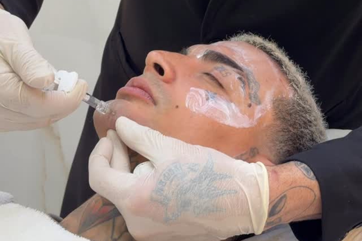 MC Guimê exibe resultado de harmonização facial. Veja antes e depois