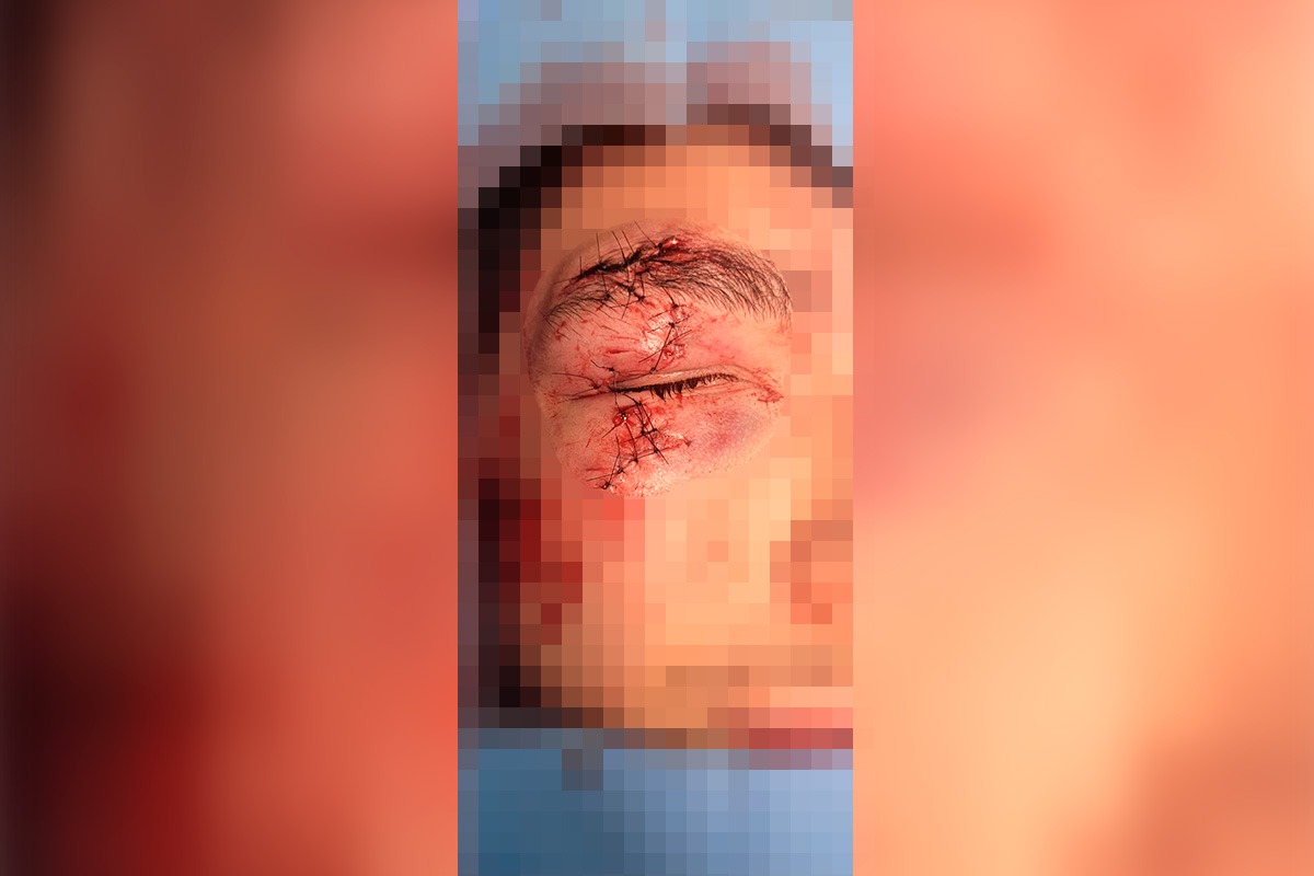 Águas Claras: suspeito de desfigurar rosto de jovem é solto no mesmo dia 14 O jovem de 18 anos sofreu cortes profundos no rosto após os óculos estourarem com o impacto do soco