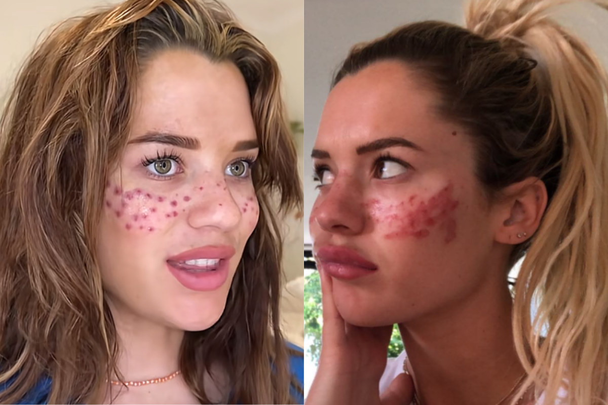 Influenciadora Compartilha Experiência após Procedimento de Beleza Mal-Sucedido