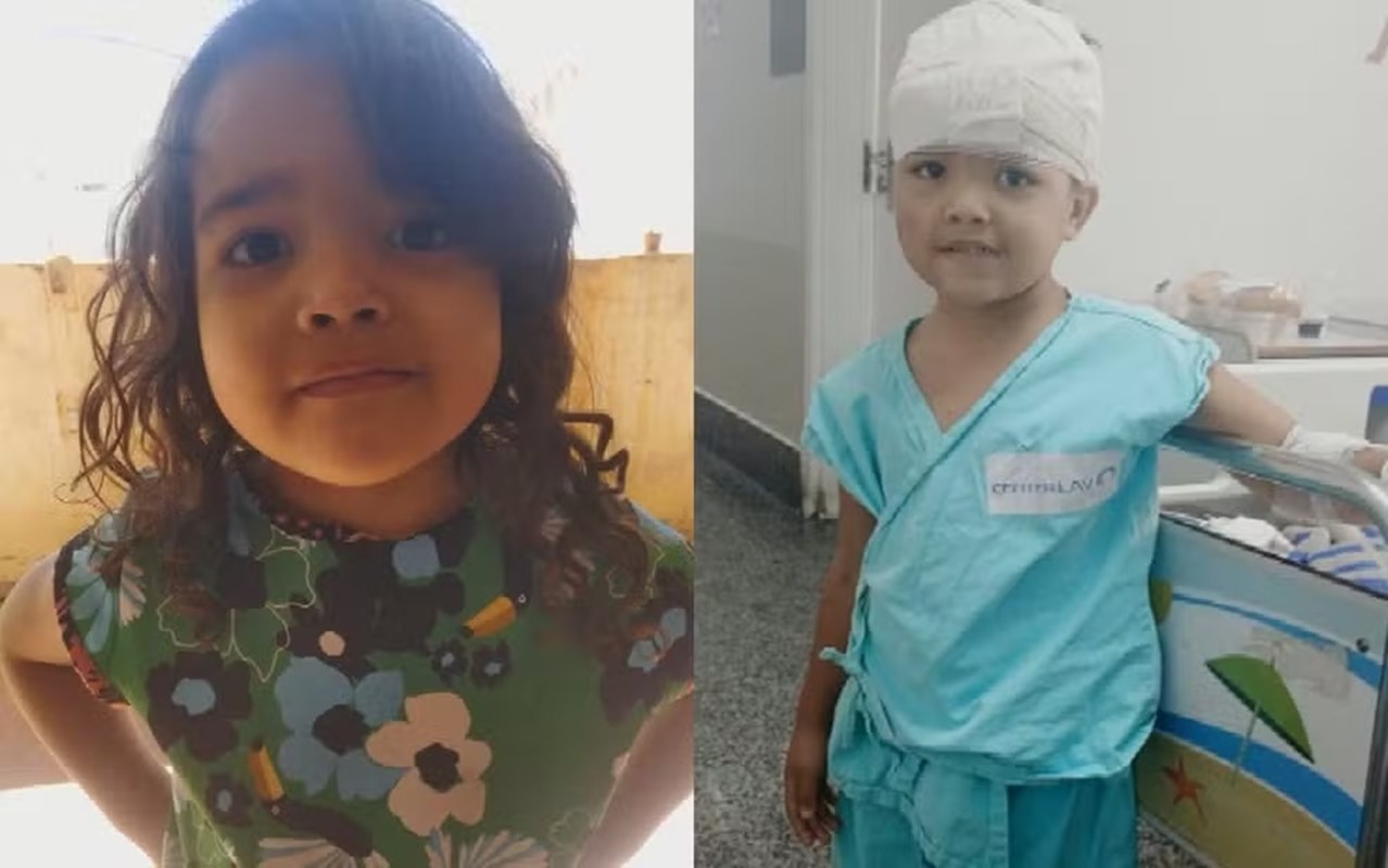 GO: menina de 4 anos é atacada na cabeça por pit-bull dentro de casa