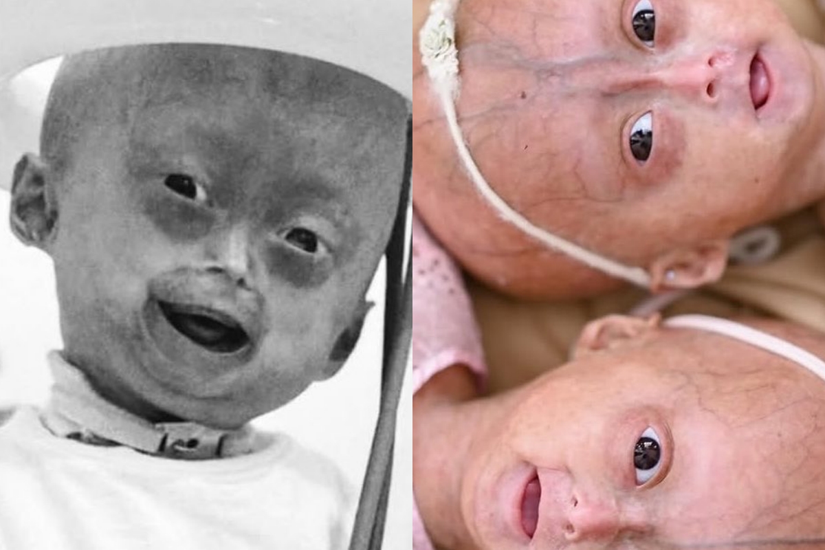Morre Elis, menina de 5 anos com síndrome rara do envelhecimento precoce