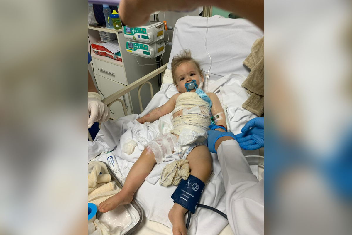 DF: bebê se recupera de queimaduras graves após acidente com água quente