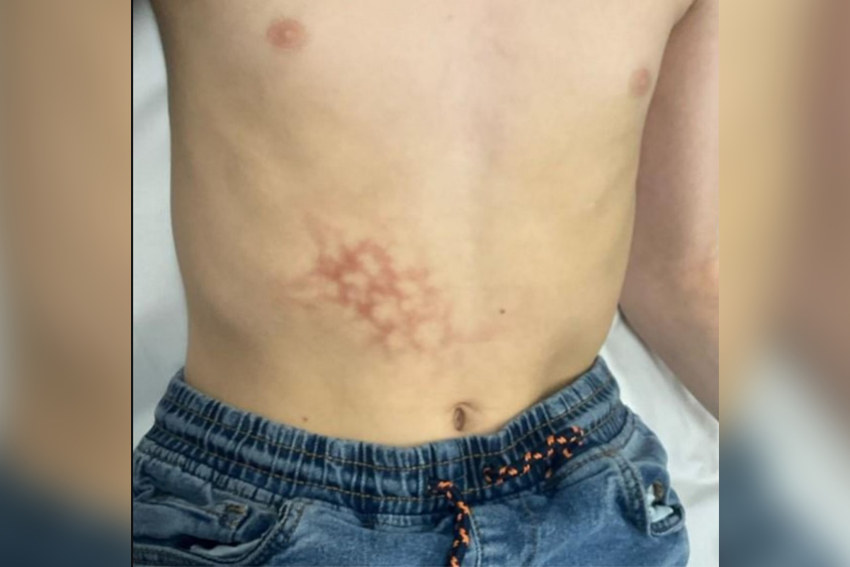 Menino desenvolve dermatose rara por usar notebook encostado na barriga
