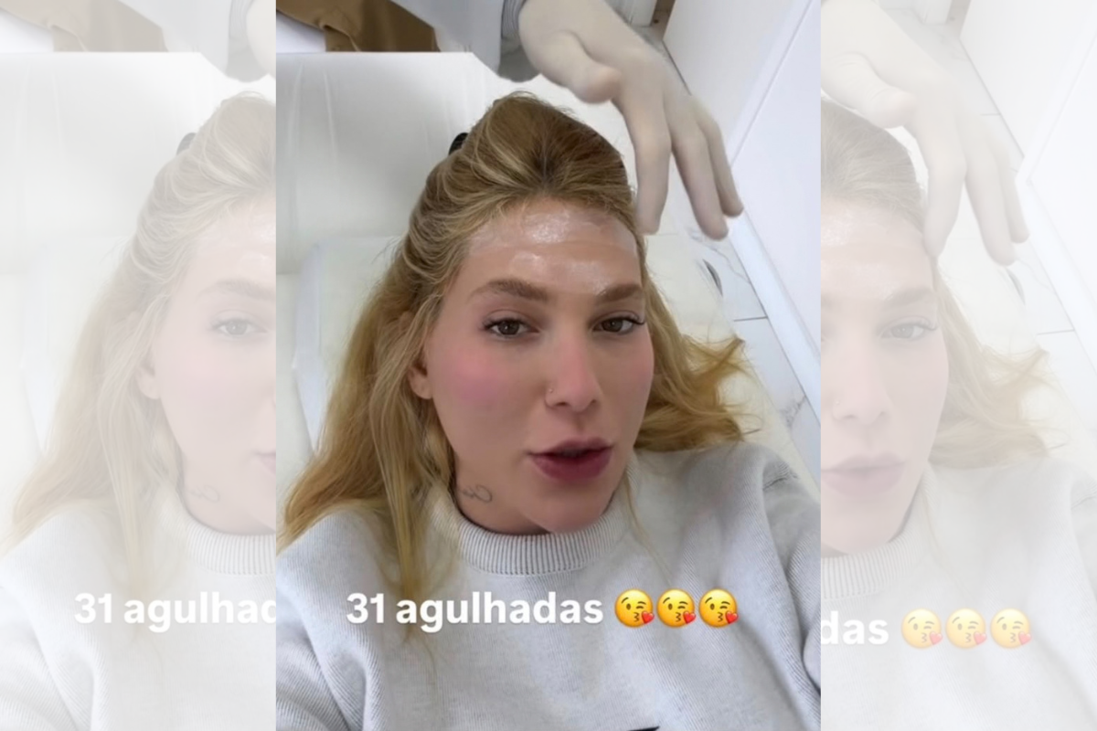 Virginia faz 31 aplicações de botox na cabeça; médica explica procedimento