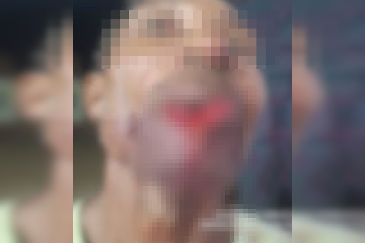 Adolescente arranca parte de lábio de homem durante briga após bebedeira