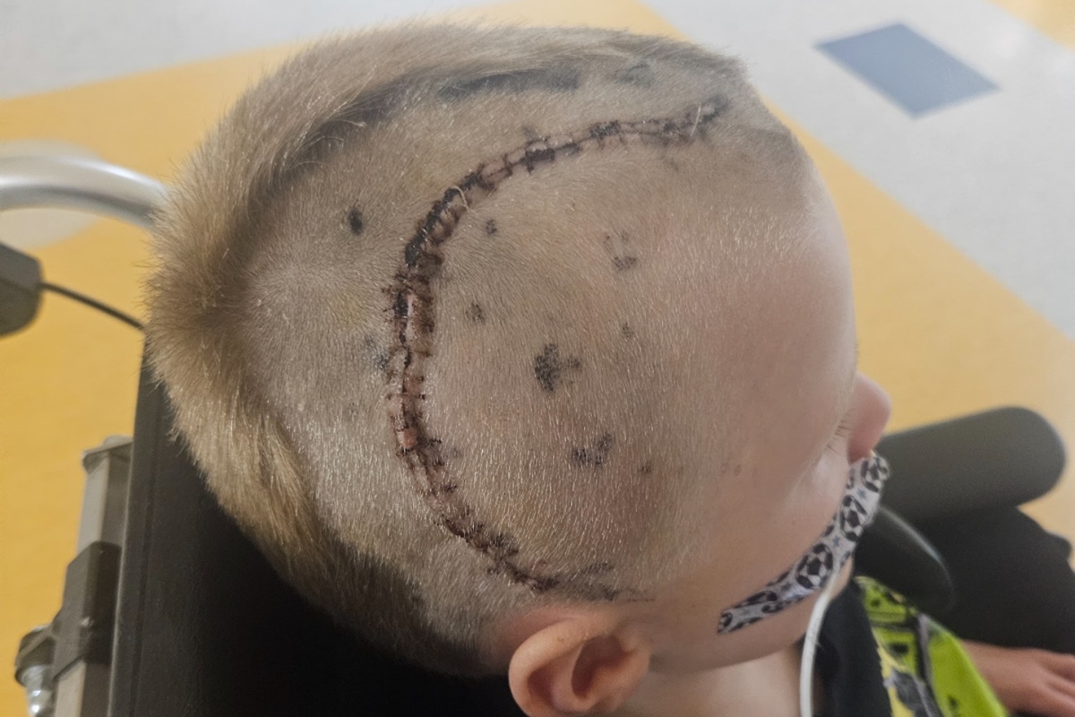 Foto colorida da cabeça de uma criança após um procedimento cirúrgico, com ênfase na cicatriz - Mretrópoles.