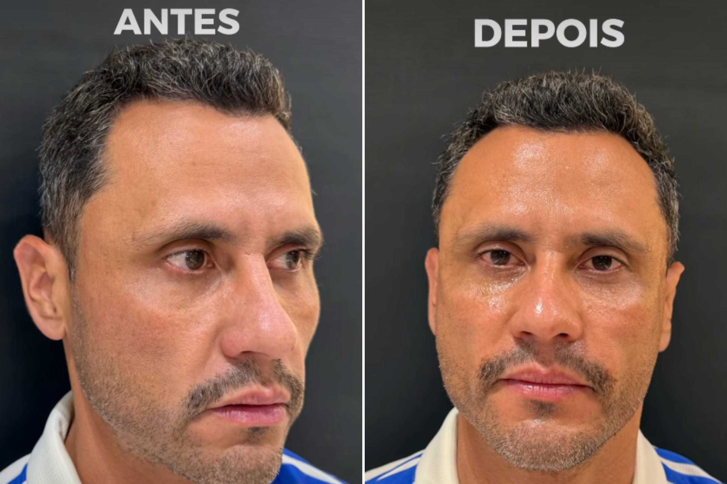 Eleito e harmonizado: Cleitinho faz procedimentos no rosto após campanha