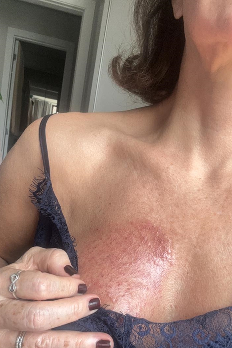 Imagem mostra mulher com mancha vermelha na mama - Metrópoles