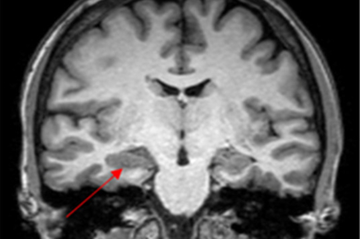 Caso de convulsão na menstruação levanta suspeita de endometriose cerebral